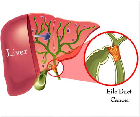 pancreatic cancer and bile duct blockage